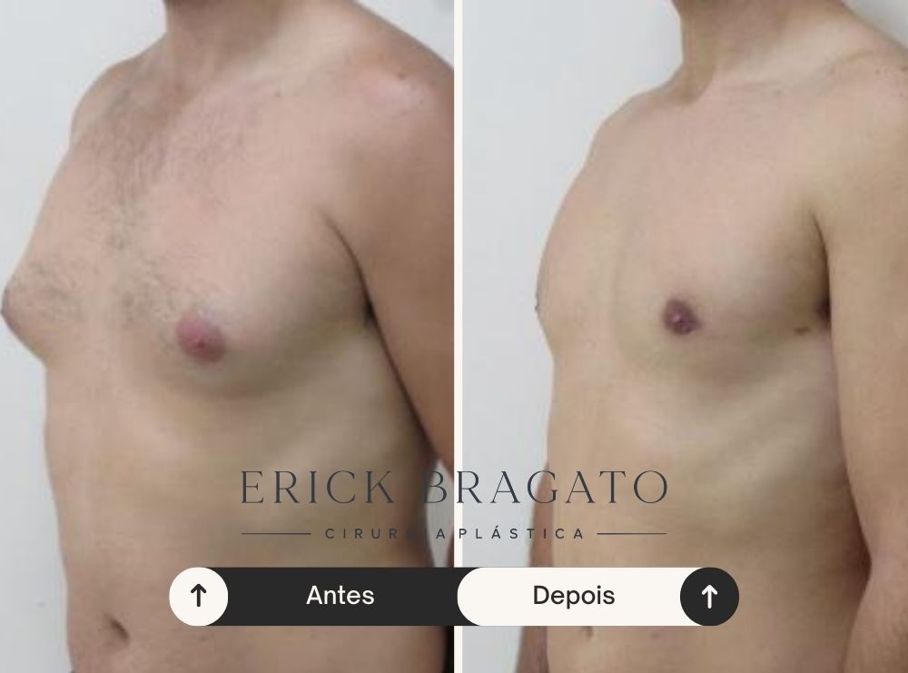Resultado de cirurgia de ginecomastia - Caso 1