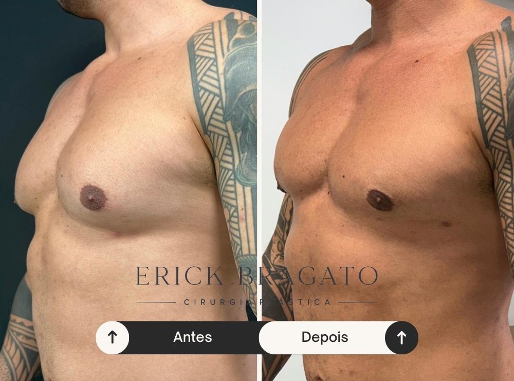 Resultado de cirurgia de ginecomastia - Caso 2