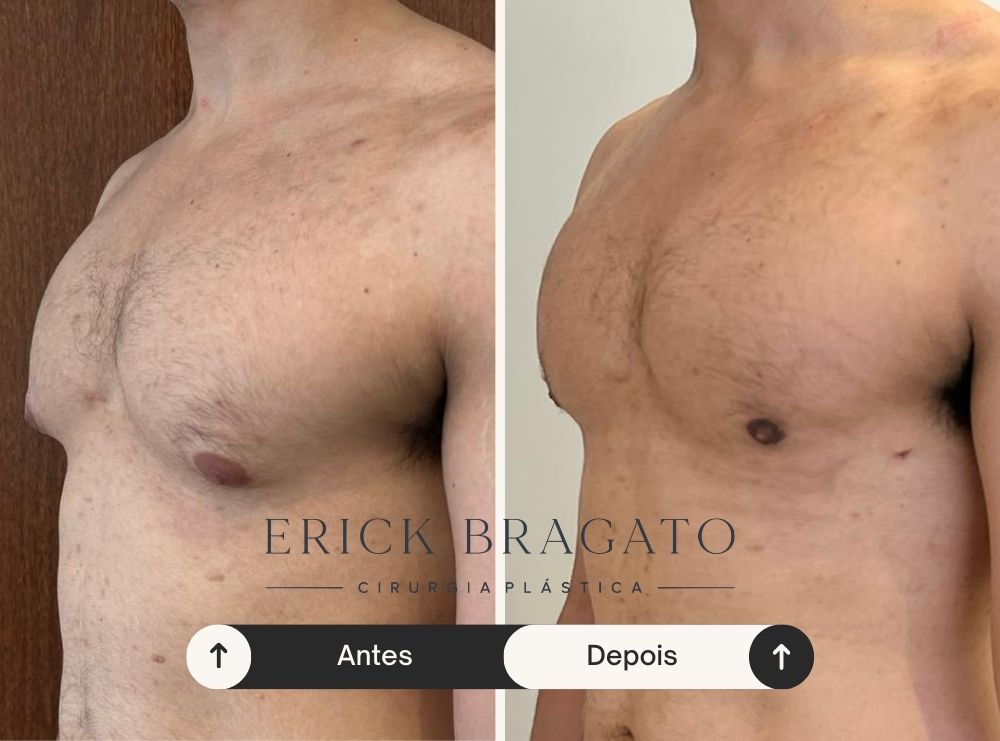 Resultado de cirurgia de ginecomastia - Caso 3