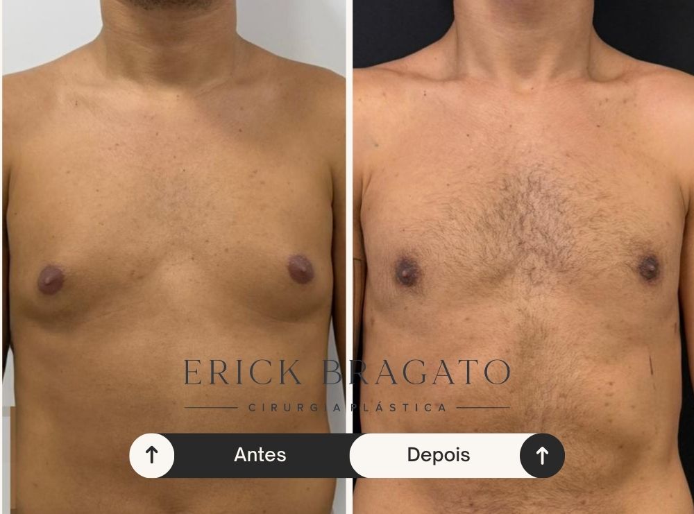 Resultado de cirurgia de ginecomastia - Caso 4