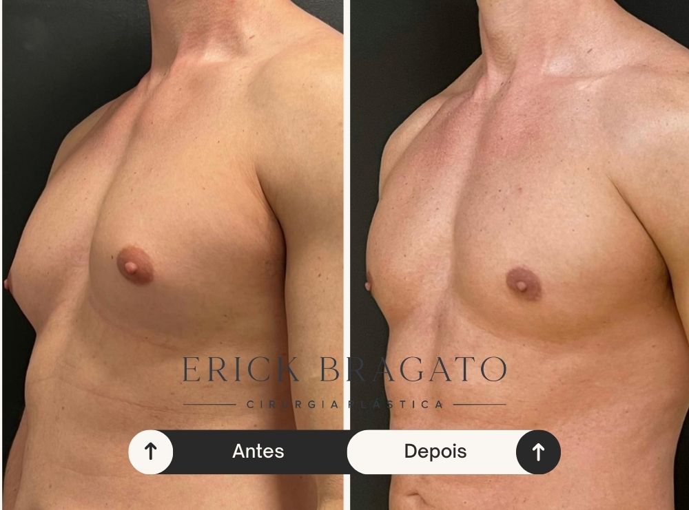 Resultado de cirurgia de ginecomastia - Caso 6