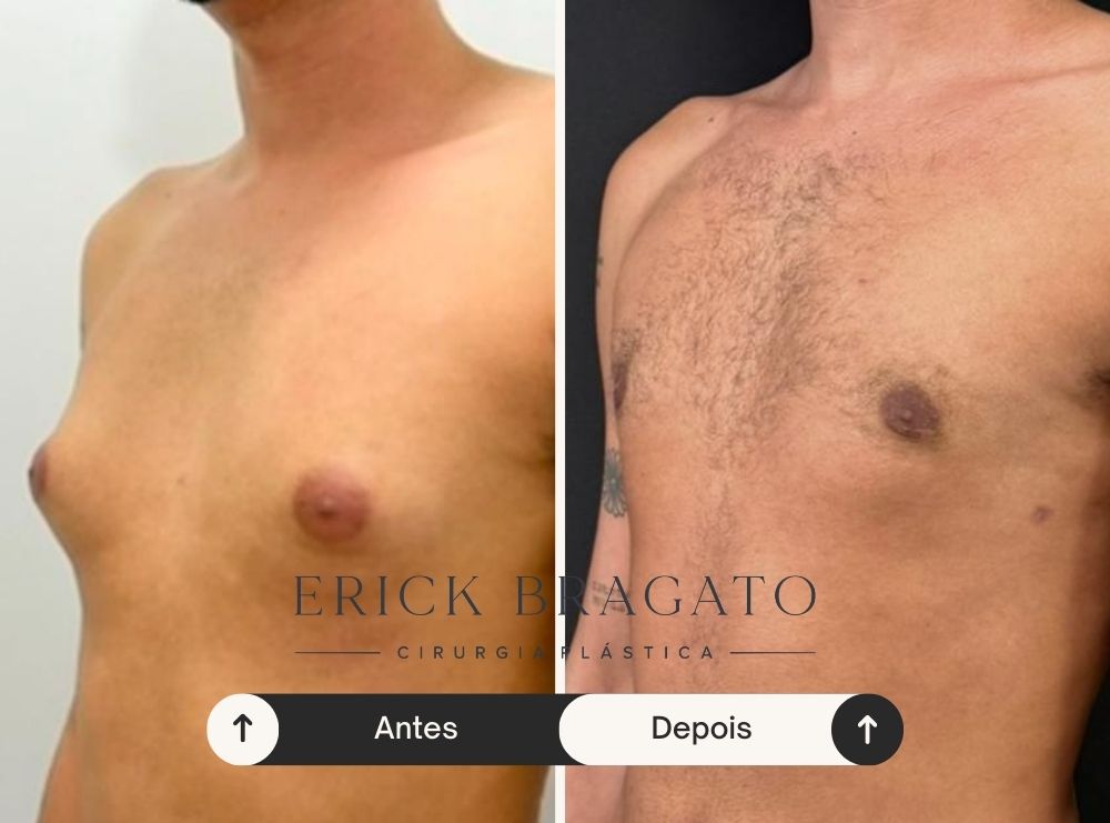 Resultado de cirurgia de ginecomastia - Caso 7